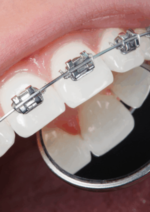 Aparat ortodontyczny Dlaczego warto iść do logopedy