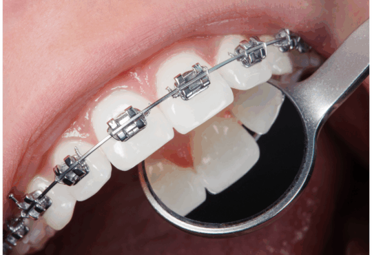 Aparat ortodontyczny Dlaczego warto iść do logopedy